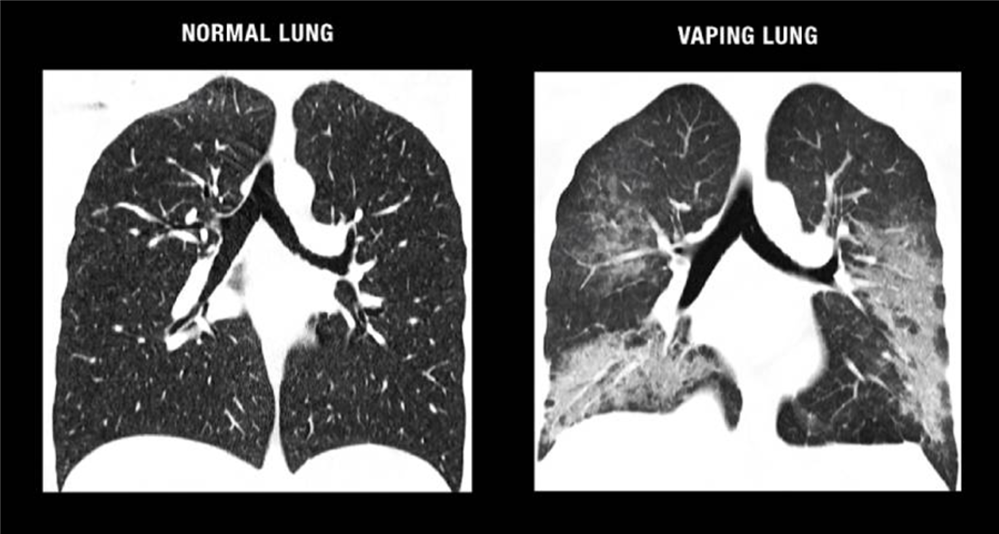 Vape Lung